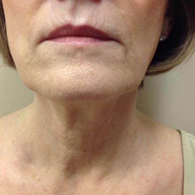 result-3-before