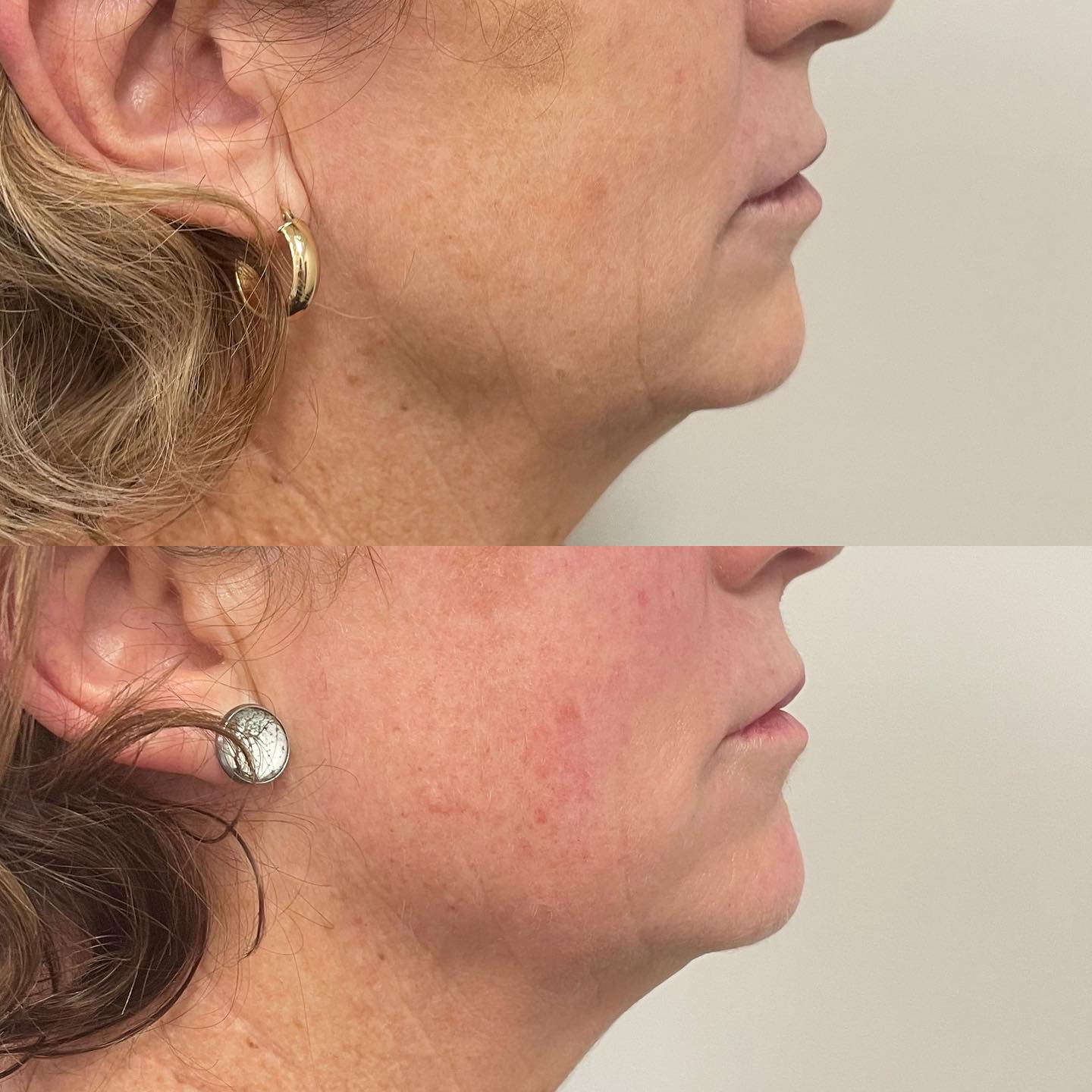 Glo2Facial Australia