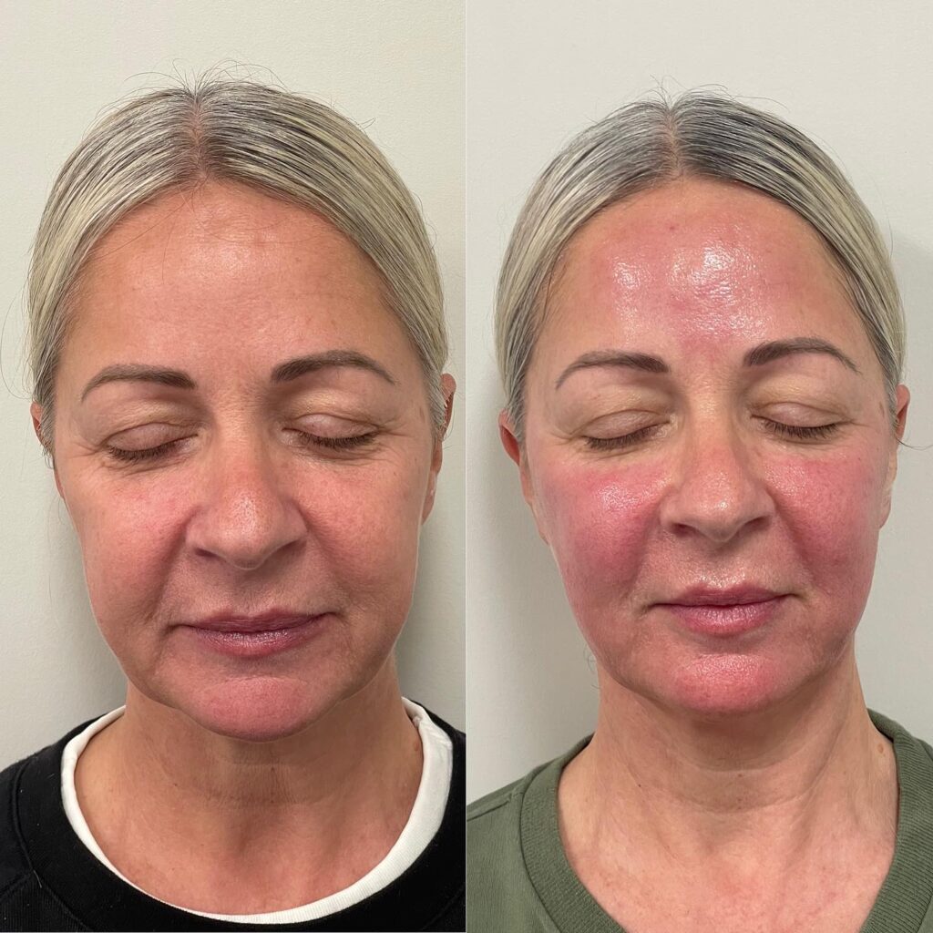 Glo2Facial Australia