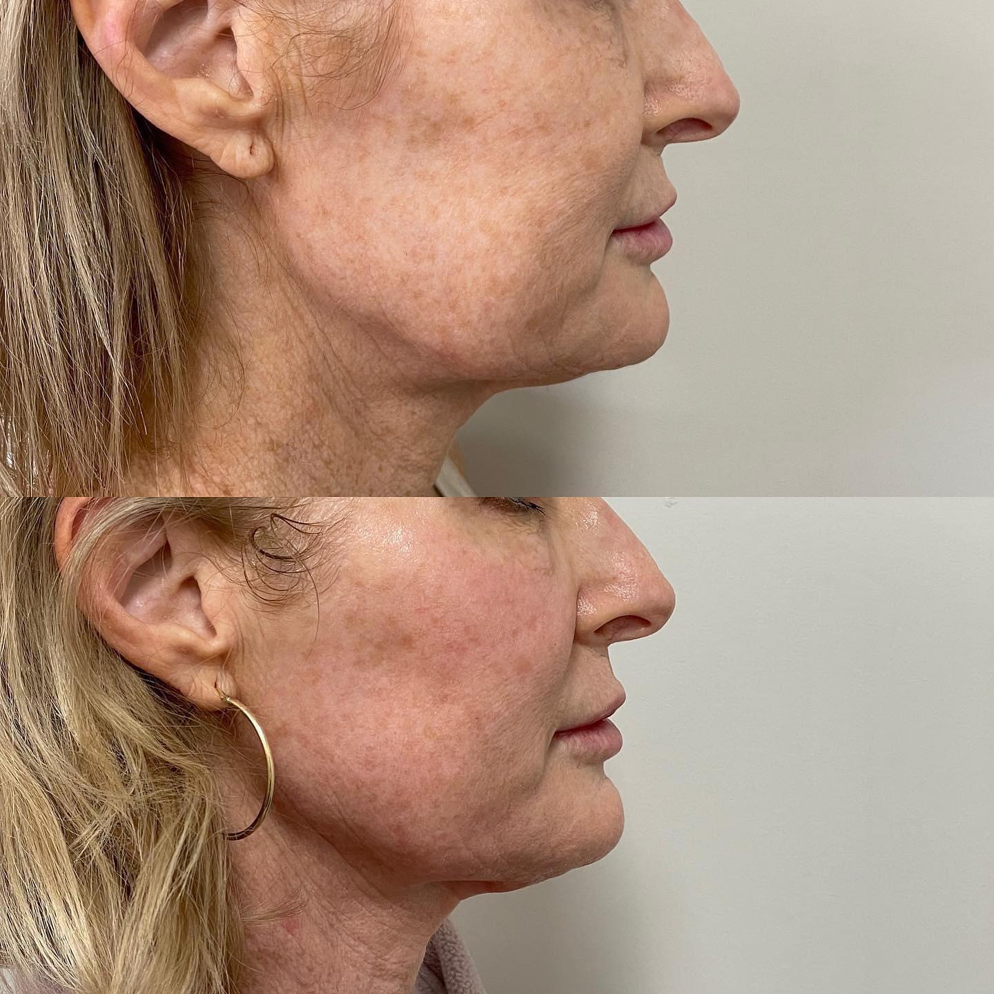 Glo2Facial Australia