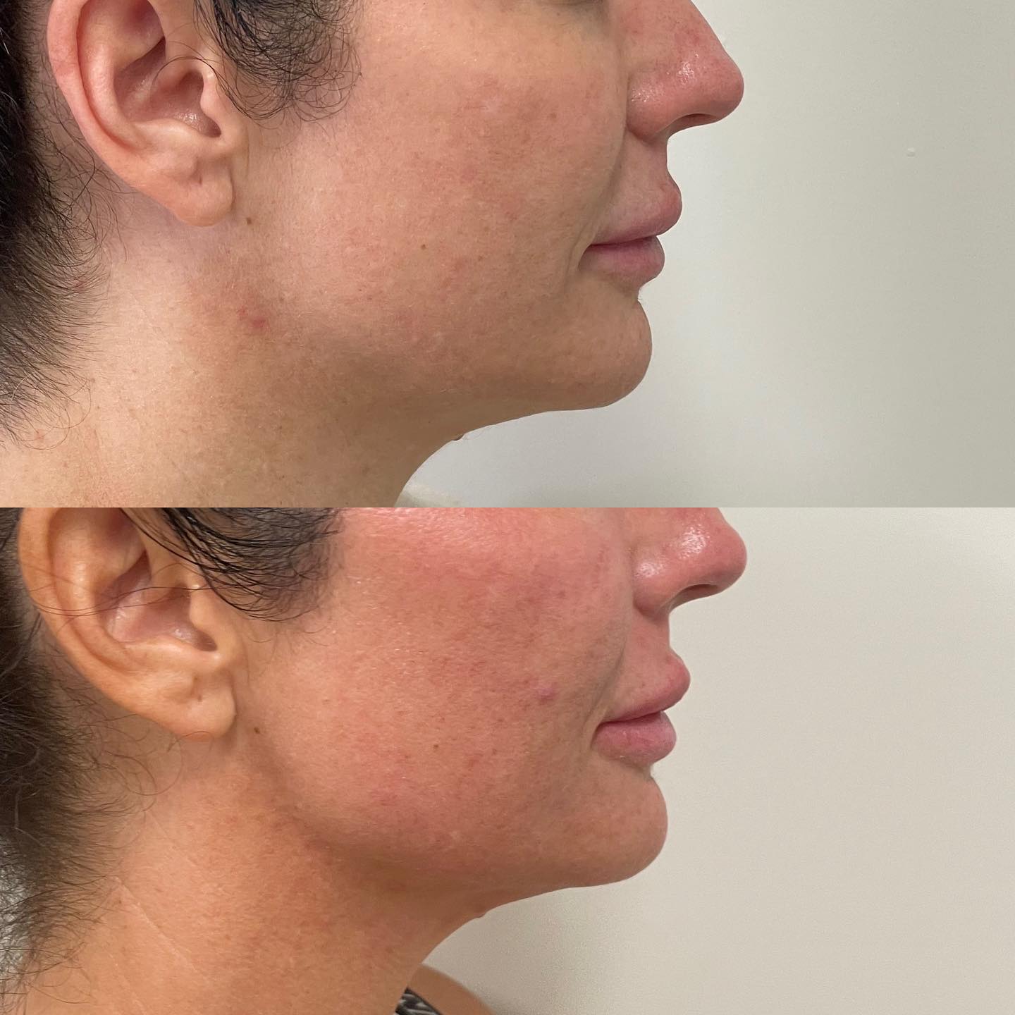 Glo2Facial Australia