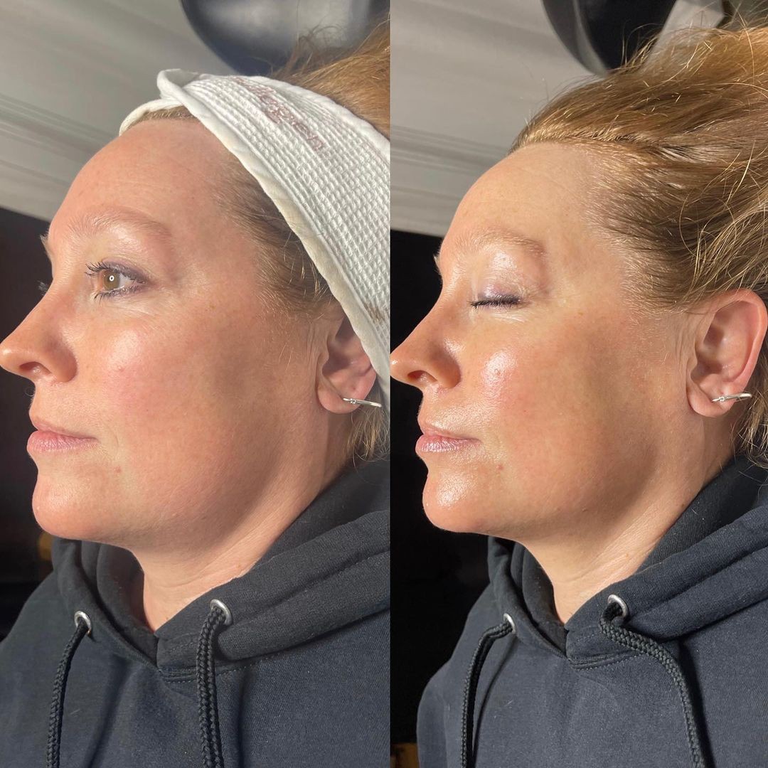 Glo2Facial Australia